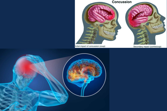 Concussions